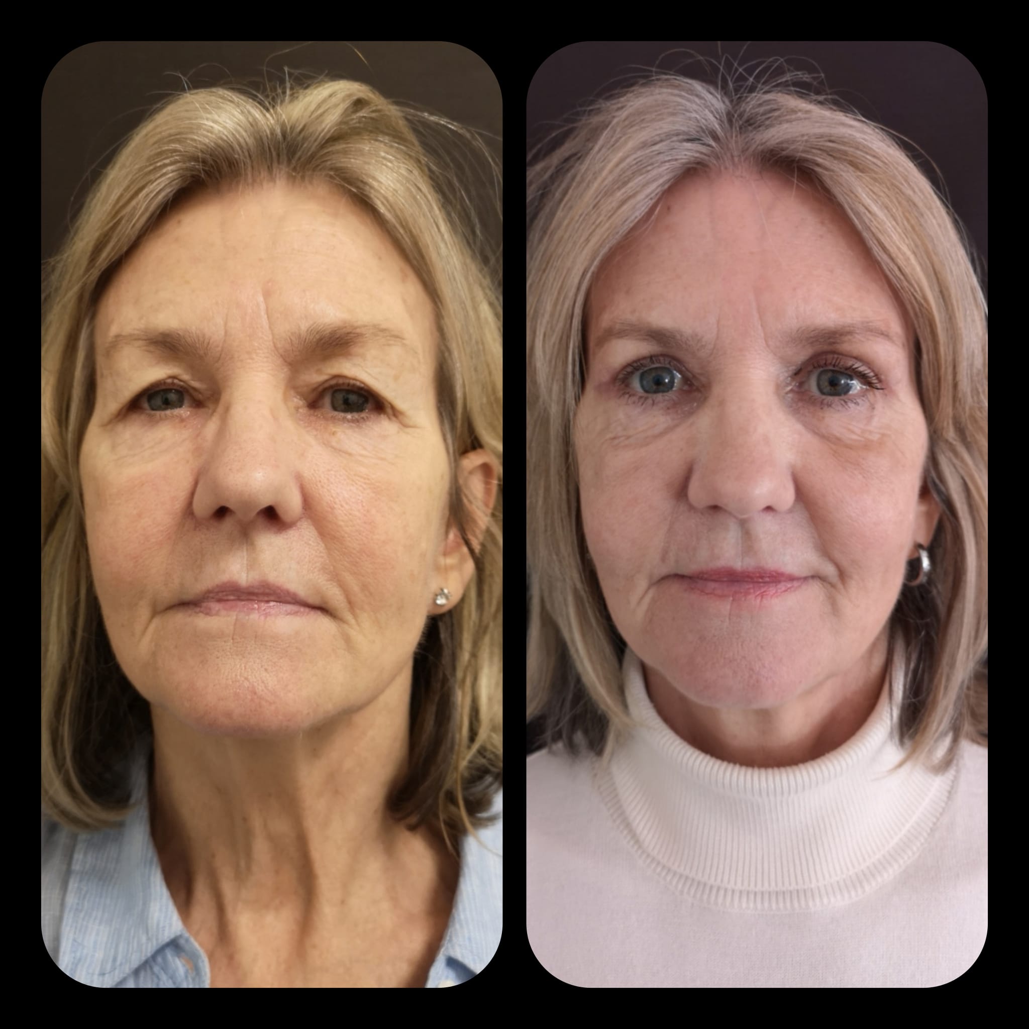 Patient vid Vivaci Klinik före och efter ögonlockskirurgi, fotograferad rakt framifrån